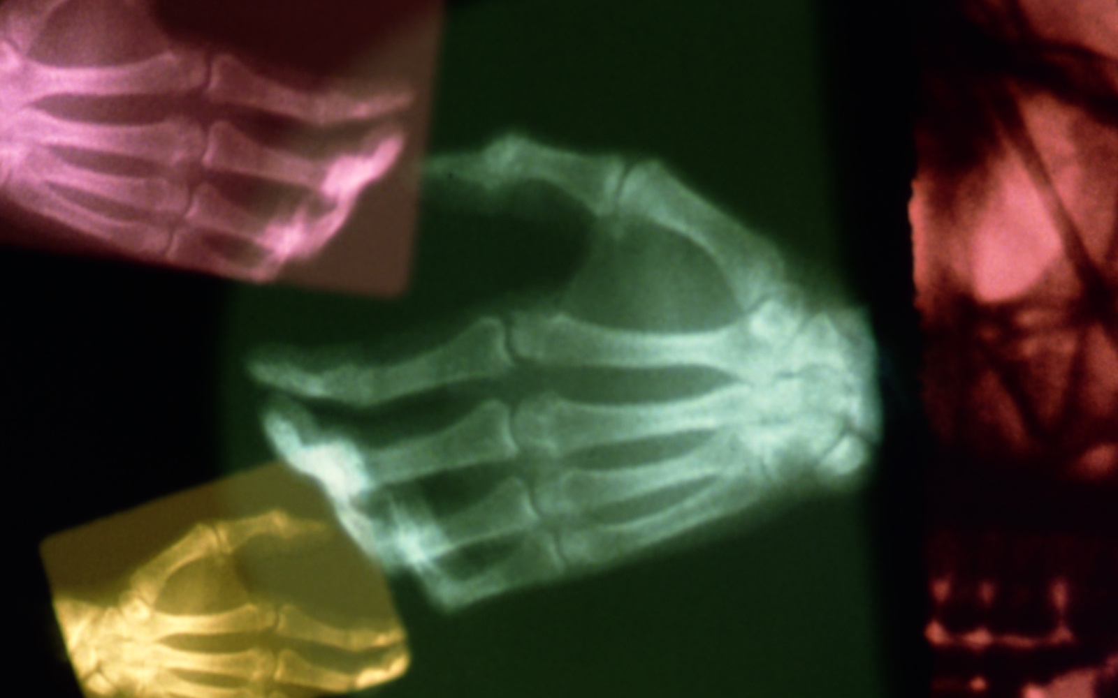 You can see three X-ray images of hands in pink, yellow and green respectively against a black background.